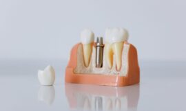 Choisir le meilleur implant dentaire avec Dental Xpert