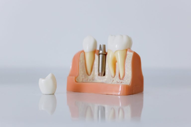 Lire la suite à propos de l’article Choisir le meilleur implant dentaire avec Dental Xpert