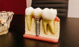 Implants dentaires : comment choisir les meilleurs pour vous ?