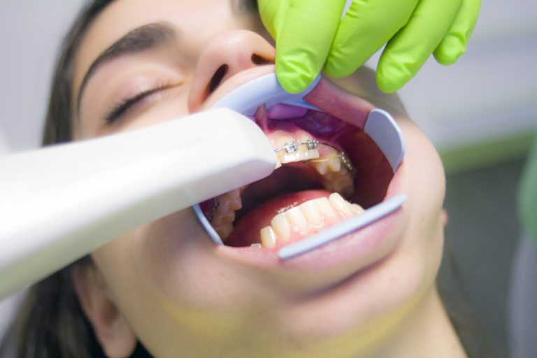 Lire la suite à propos de l’article Coût du traitement orthodontique multibagues au Maroc