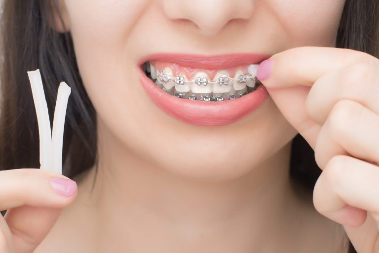 Lire la suite à propos de l’article Comment utiliser la cire orthodontique au Maroc