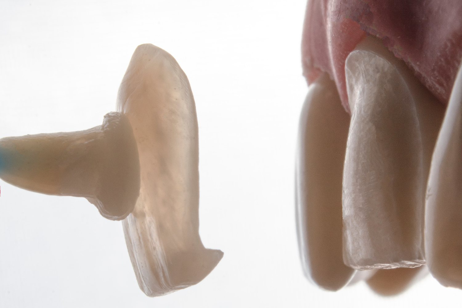 Zoom sur l'étape de coulage d'une facette dentaire dans un laboratoire turc