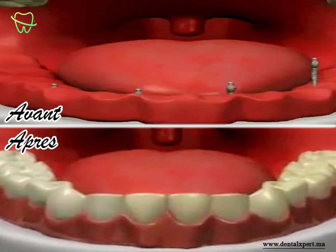 Schéma illustrant la transformation dentaire avant et après l'implantation de 4 mini-implants dentaires au Maroc.