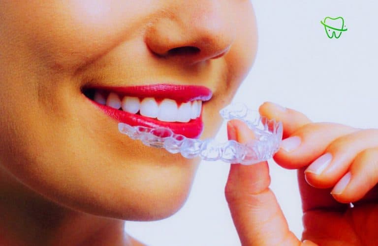 Lire la suite à propos de l’article Prix d’Invisalign au Maroc : Guide complet