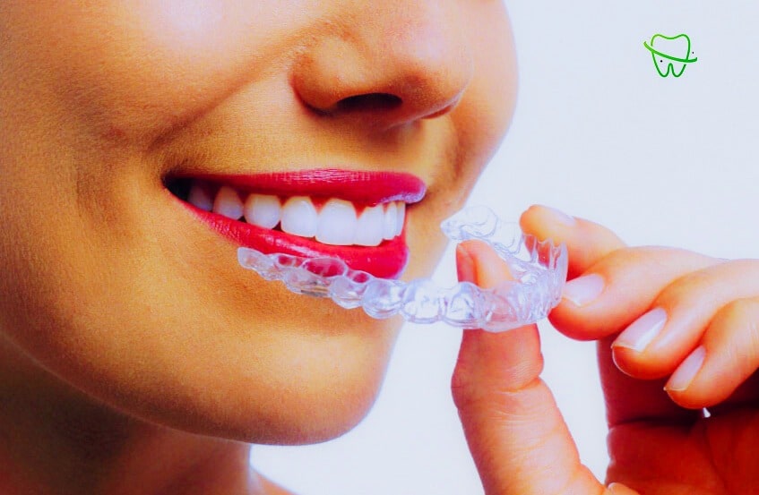 Fille souriante montrant des dents parfaitement alignées et tenant un aligner Invisalign transparent