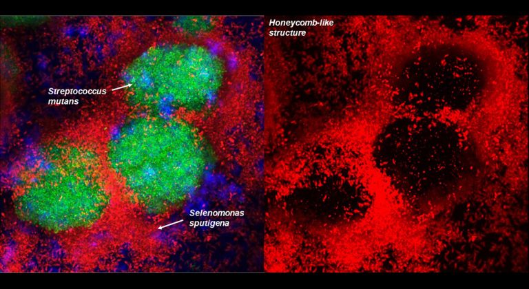 Lire la suite à propos de l’article Découverte d’une Nouvelle Bactérie Jouant un Rôle Majeur dans les Caries Dentaires : Selenomonas sputigena