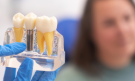 Combien d’Implants Dentaires Peut-on Poser en une Seule Fois ?