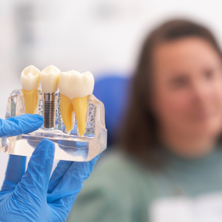 Lire la suite à propos de l’article Combien d’Implants Dentaires Peut-on Poser en une Seule Fois ?