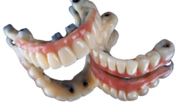 Prothèses Dentaires sur Implants : Tout ce que Vous Devez Savoir